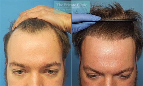 Fue Hair Transplant Mm Front The Private Clinic Of Harley Street