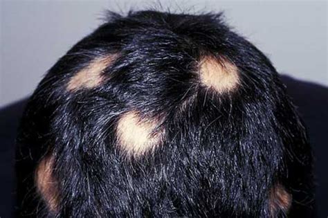 Hair Loss The Second Encounter Three Common Types Novuhair
