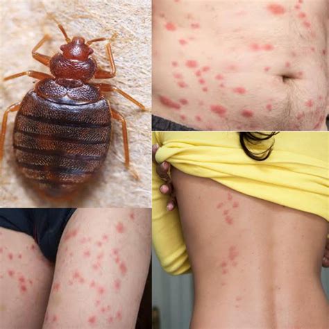 Infected Bed Bug Bites