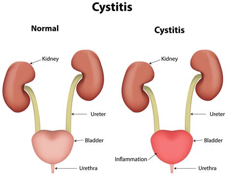 Common Things About Cystitis And Its Herbal Cure