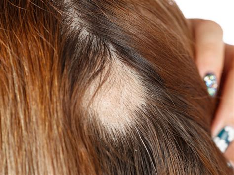 Alopecia Areata Overview Types Causes Symptoms And Treatment Pfizer