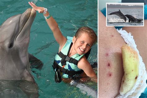 Aggressive Dolphin Attacks Are On The Rise As 10 Year Old Is Mauled On