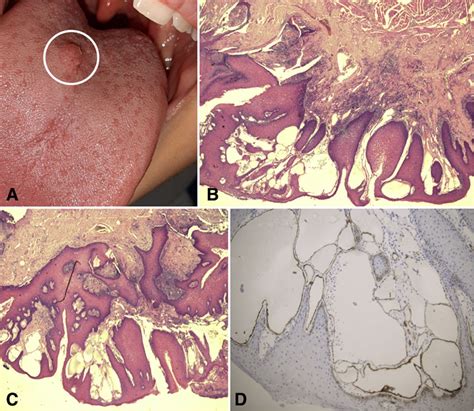 Localised Swelling Of The Tongue A Rare Case Of Isolated Angiokeratoma