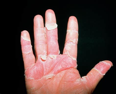 Dermatitis On A Mans Hand Due To Stress Photograph By Alex Bartel