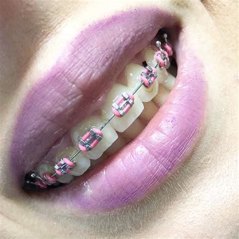 the best braces colors for girls to wear braces explained