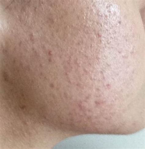Tiny Red Pimples All Over Cheeks Help General Acne Discussion By