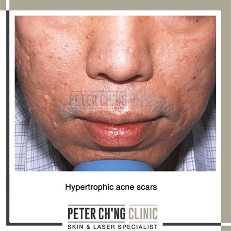 5 Bad Habits That Can Cause Acne Scars Peter Chng Skin Specialist