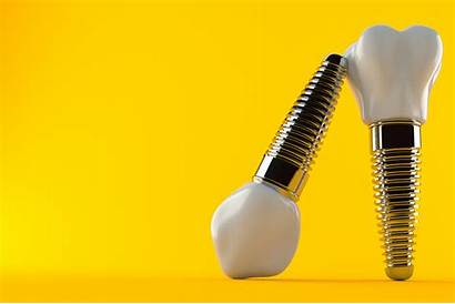 Dental Dentures Implants Rethink Reasons Many