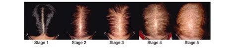 7 stages of hair loss. Sinclair scale for female pattern hair loss. Stage 1 is ...