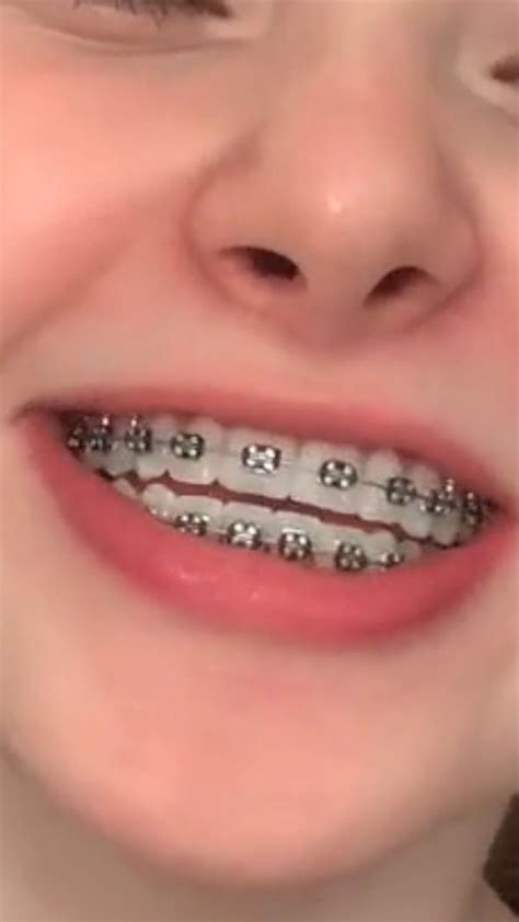 fake braces adult braces braces tips metal braces silver braces pretty teeth beautiful