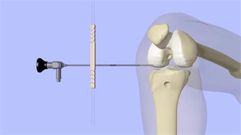 Acl Reconstruction Surgery Youtube
