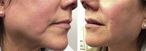 Simultaneous Bilateral Hypertrophies Of The Parotid Gland And Masseter