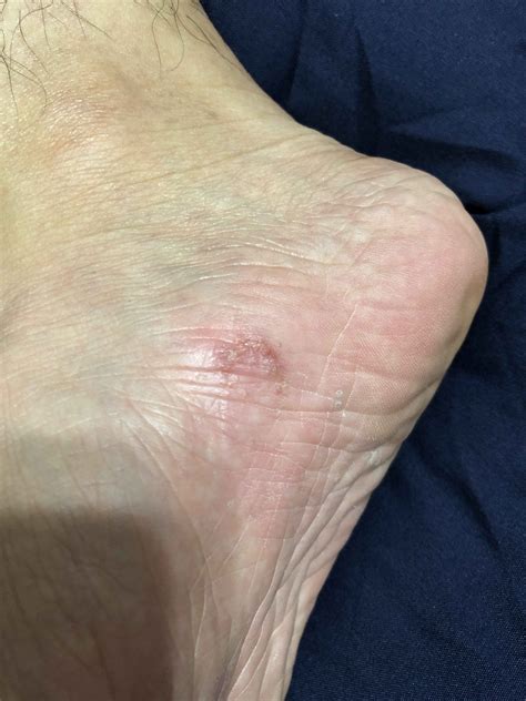 What Are The Symptoms Of Athletes Foot Tinea Pedis And Ringworm