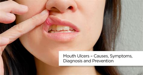 Mouth Ulcer Mouth Ulcer Treatment Causes And Symptoms