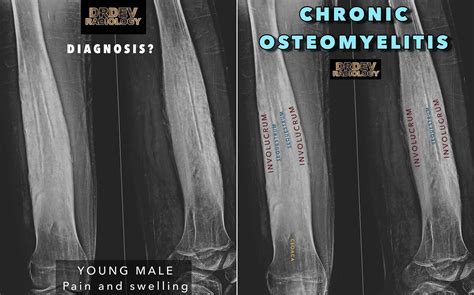 Chronic Osteomyelitis On Femur X Ray Characteristic Grepmed