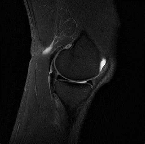 Sagittal Knee 3t T2 1 Radiology Library