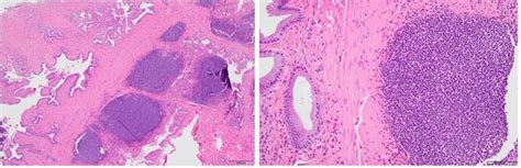 Cureus Extranodal Marginal Zone Mucosa Associated Lymphoid Tissue