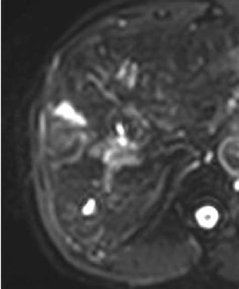 Mri Image Of Hepatocellular Carcinoma A T2wi B T1wi C Dwi D