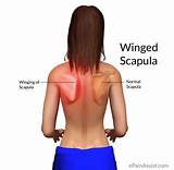 Pictures of Winged Scapula Rehabilitation Exercises