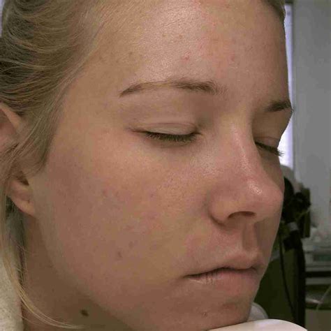 Acne En Littekens Behandelingen Met Laser Skin Kliniek