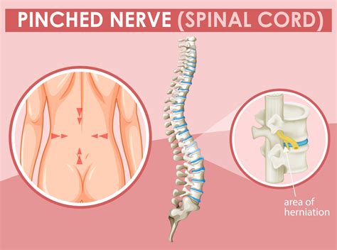 Royal Palm Beach Chiropractor Explains What Is A Pinched Nerve