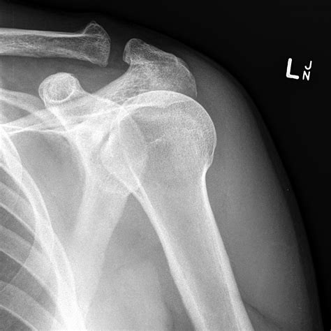 Normal Shoulder Joint X Ray