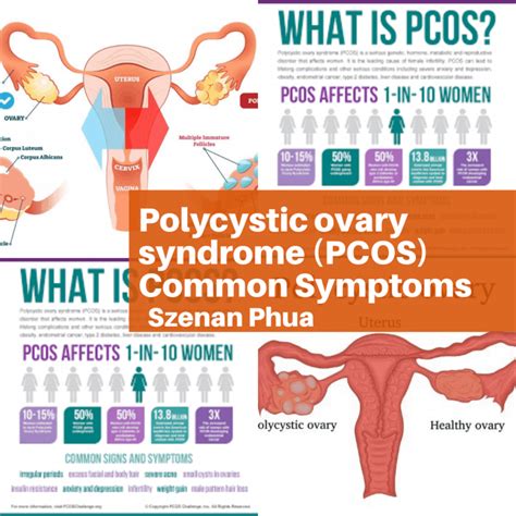 Infographic Pcos Symptoms Pcos Symptoms Pcos Ovarian Cyst My XXX Hot Girl