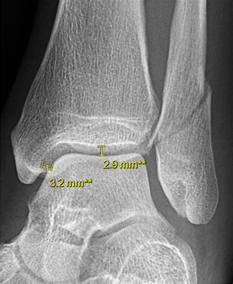Regular Mortise Radiograph With A Medial Clear Space Mcs Of 32 Mm