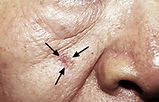 Actinic keratosis: Overview