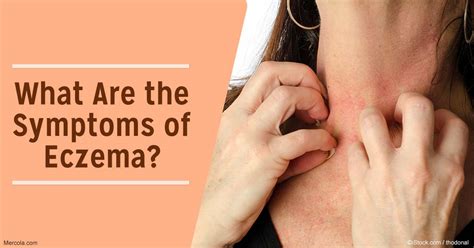 What Are The Symptoms Of Eczema