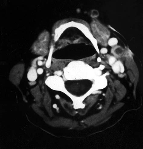Imaging Appearance Of Nontuberculous Mycobacterial Infection Of The Neck