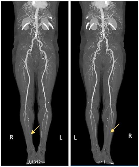 Cureus Covid 19 Induced Bilateral Lower Limb Ischemia And Visceral