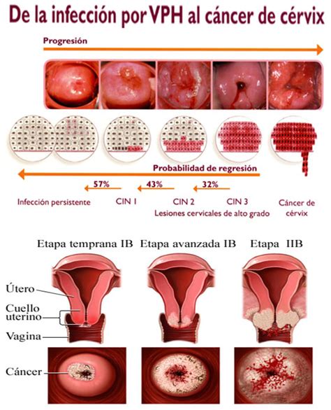 See more of cancer de utero (virus hpv) on facebook. Información sobre el cáncer de cuello de útero - Cáncer de ...