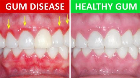The Most Common Causes Of Gum Disease Regency Dental