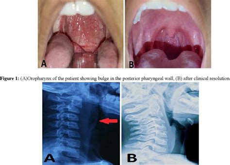 Figure 1 From Retropharyngeal Abscess As A Complication Of Cervical