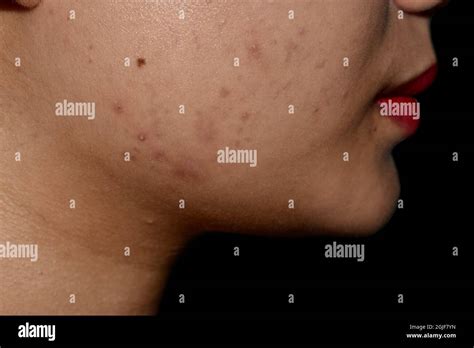 Chloasma Or Melasma Black Spots And Acne Scars On Face Of Asian Young