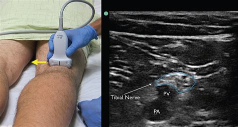 How To Perform Ultrasound Guided Distal Sciatic Nerve Block In The