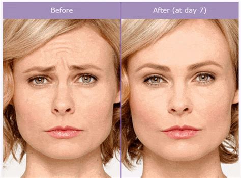 Botox Before And After Pictures Jersey City Newark Nj