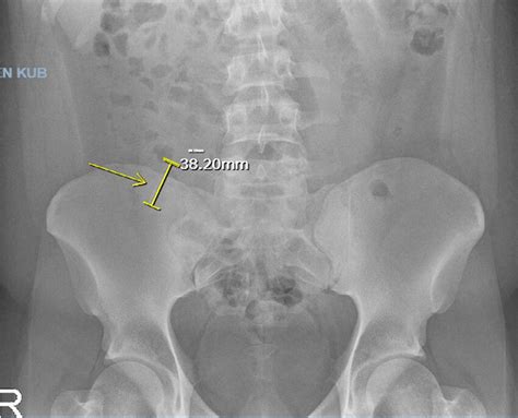 X Ray Of Abdomen Demonstrating Partial Small Bowel Obstruction A