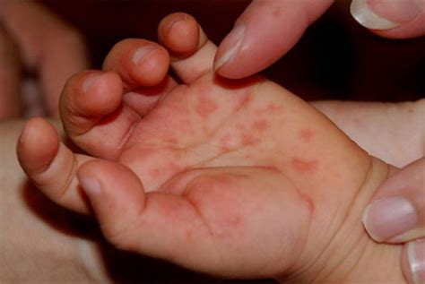 Massive Outbreak Of Hand Foot And Mouth Disease In Sydney Mum S Lounge