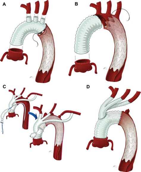 State Of The Art Surgical Management Of Acute Type A Aortic Dissection