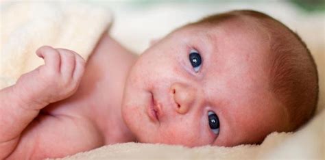 Newborn Skin Conditions Bumps On Babys Face