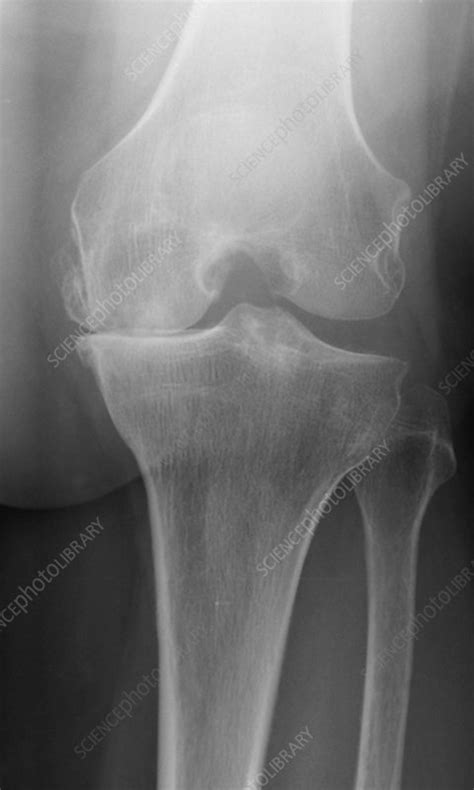 Osteoarthritis Of The Knee X Ray Stock Image C0292444 Science