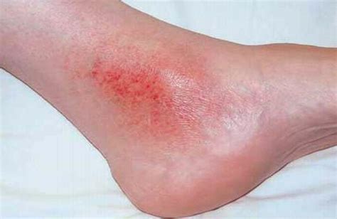 Ankle Rash Causes Symptoms Diagnosis Treatment Prevention And More