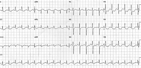 St Depression Does Not Localise Litfl Ecg Library