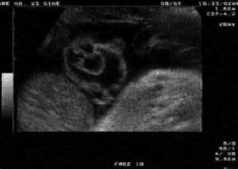 Imagen Ultrasonográfica Que Muestra Ectopia Cordis Y Onfalocele En Un