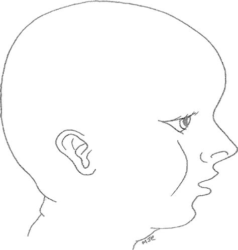 Plagiocephaly Brachycephaly And Cranial Orthotic Devices Misshapen