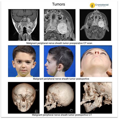 Pediatric Head And Neck Tumor Gallery Craniofacial Team Of Texas Austin