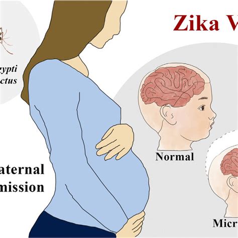 zika virus associated microcephaly when a pregnant woman is infected download scientific