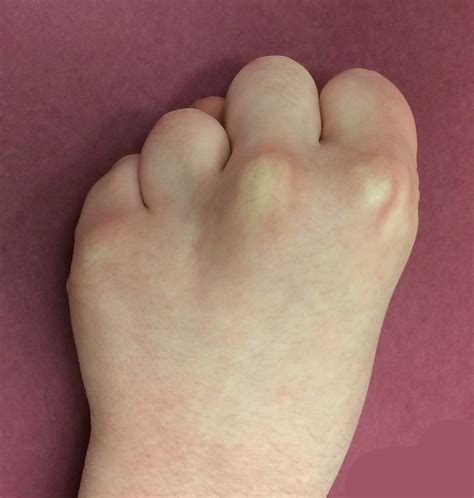 The Short 4th Metacarpal Congenital Hand And Arm Differences